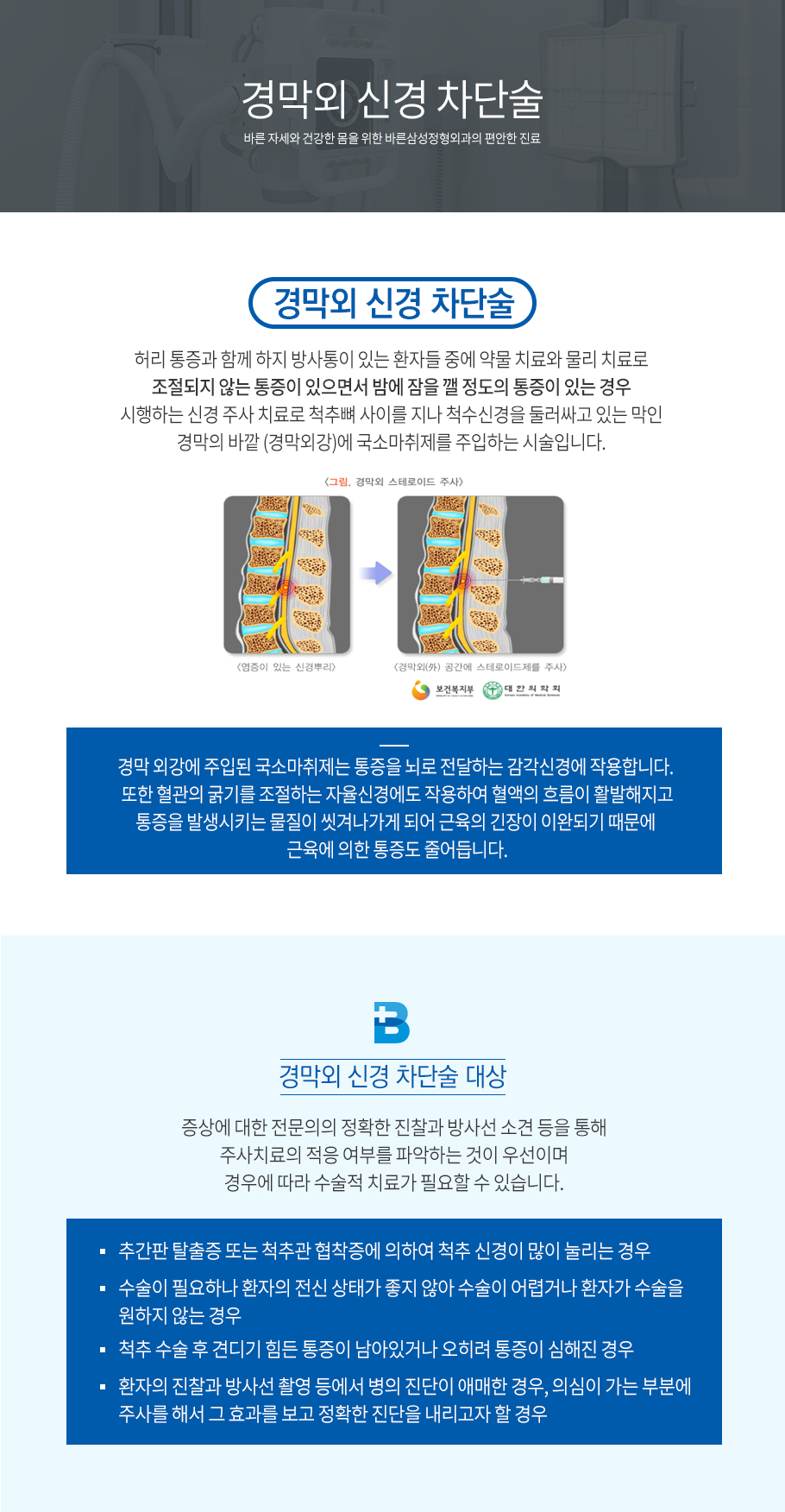 경막외신경차단술